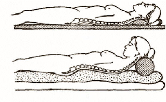 Osteokondrosiaren figura